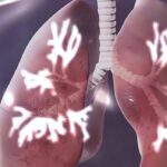 Правительство утвердило национальную программу по борьбе с туберкулёзом на 2026–2030 годы